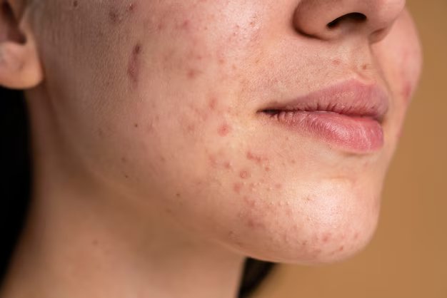 Read more about the article What Is Dry Skin Problems?  Symptoms, Reasons, Remedies